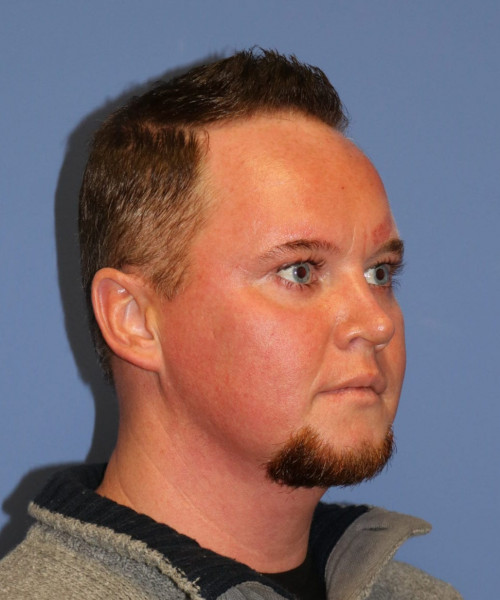 Rhinoplasty #6818 – click HERE for more views after photo. Individual results may vary.