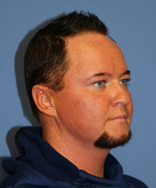 Rhinoplasty #6818 – click HERE for more views before photo. Individual results may vary.