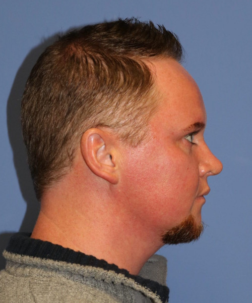 Rhinoplasty #6818 – click HERE for more views after photo. Individual results may vary.