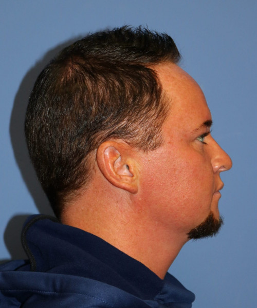 Rhinoplasty #6818 – click HERE for more views before photo. Individual results may vary.