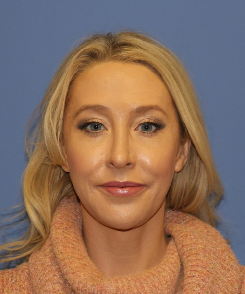 Rhinoplasty #6889 – click HERE for more views after photo. Individual results may vary.