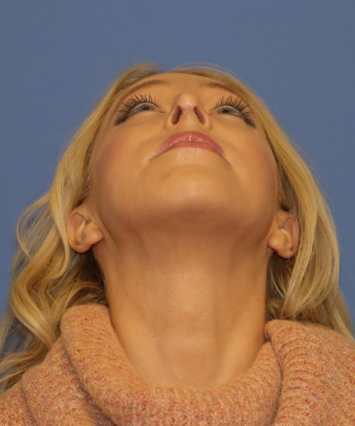 Rhinoplasty #6889 – click HERE for more views after photo. Individual results may vary.