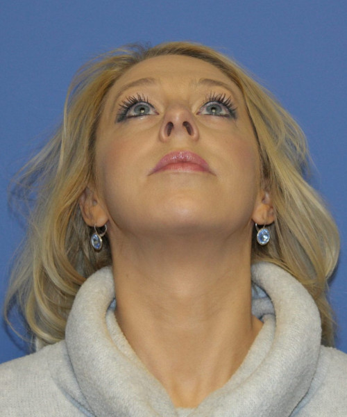 Rhinoplasty #6889 – click HERE for more views before photo. Individual results may vary.