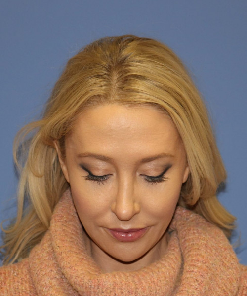 Rhinoplasty #6889 – click HERE for more views after photo. Individual results may vary.