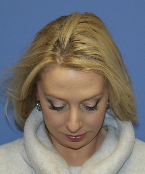 Rhinoplasty #6889 – click HERE for more views before photo. Individual results may vary.