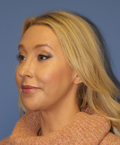 Rhinoplasty #6889 – click HERE for more views after photo. Individual results may vary.
