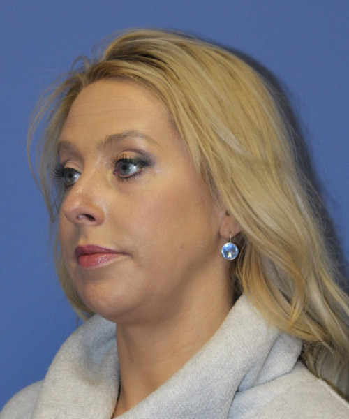 Rhinoplasty #6889 – click HERE for more views before photo. Individual results may vary.