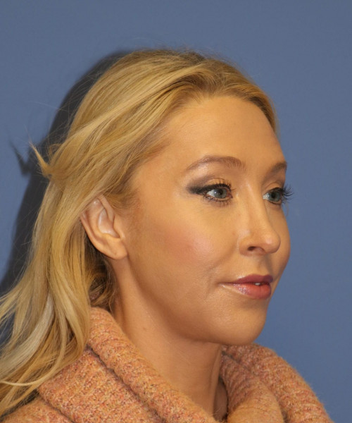 Rhinoplasty #6889 – click HERE for more views after photo. Individual results may vary.