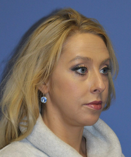 Rhinoplasty #6889 – click HERE for more views before photo. Individual results may vary.