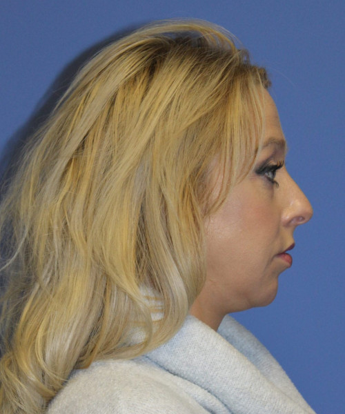 Rhinoplasty #6889 – click HERE for more views before photo. Individual results may vary.