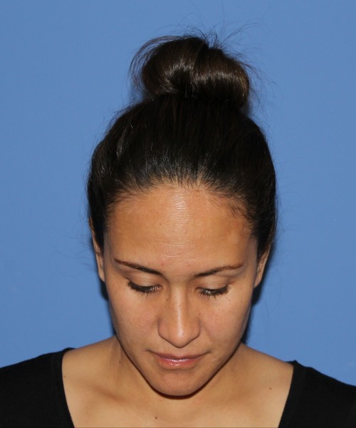 Rhinoplasty 0696 – Click HERE for more views after photo. Individual results may vary.