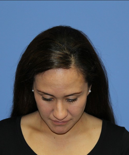 Rhinoplasty 0696 – Click HERE for more views before photo. Individual results may vary.