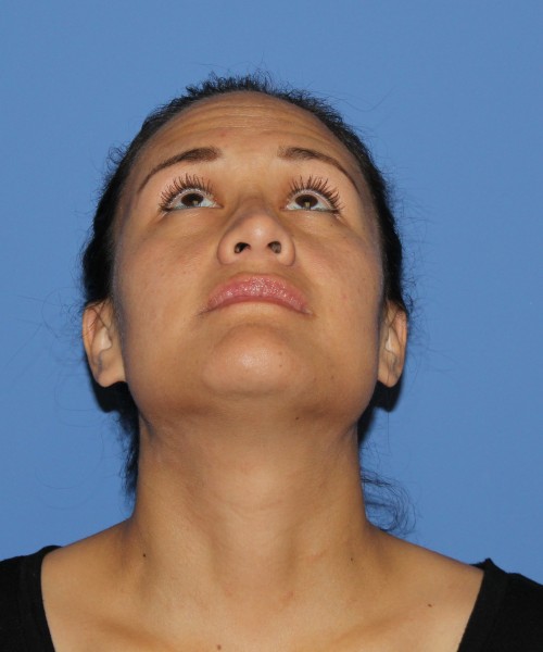 Rhinoplasty 0696 – Click HERE for more views after photo. Individual results may vary.