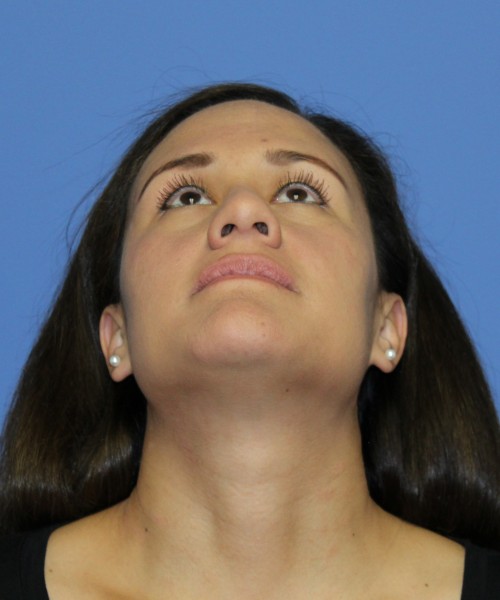Rhinoplasty 0696 – Click HERE for more views before photo. Individual results may vary.
