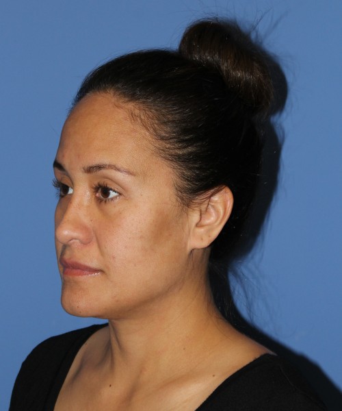 Rhinoplasty 0696 – Click HERE for more views after photo. Individual results may vary.