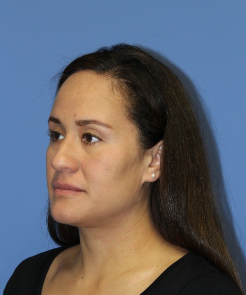 Rhinoplasty 0696 – Click HERE for more views before photo. Individual results may vary.