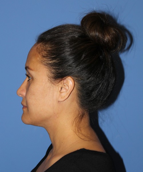Rhinoplasty 0696 – Click HERE for more views after photo. Individual results may vary.