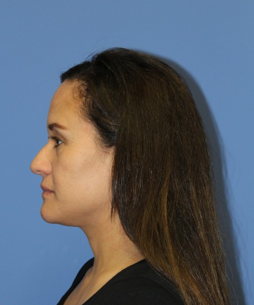Rhinoplasty 0696 – Click HERE for more views before photo. Individual results may vary.