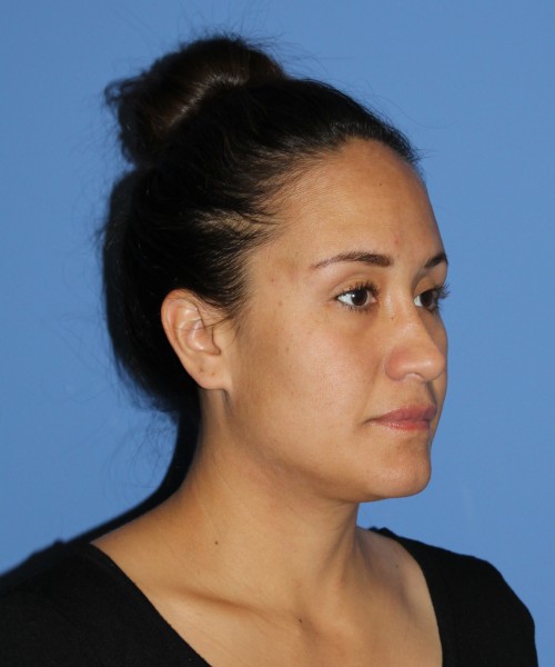 Rhinoplasty 0696 – Click HERE for more views after photo. Individual results may vary.