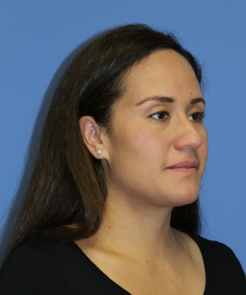 Rhinoplasty 0696 – Click HERE for more views before photo. Individual results may vary.