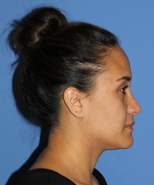 Rhinoplasty 0696 – Click HERE for more views after photo. Individual results may vary.