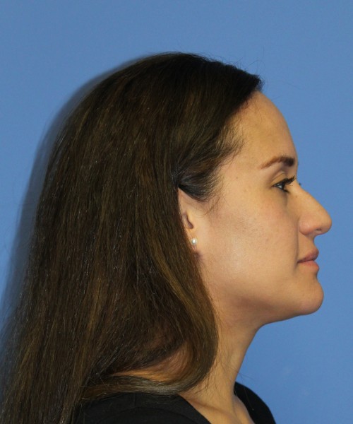 Rhinoplasty 0696 – Click HERE for more views before photo. Individual results may vary.
