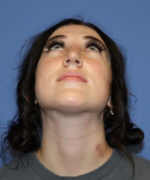 Rhinoplasty #6975 – click HERE for more views after photo. Individual results may vary.