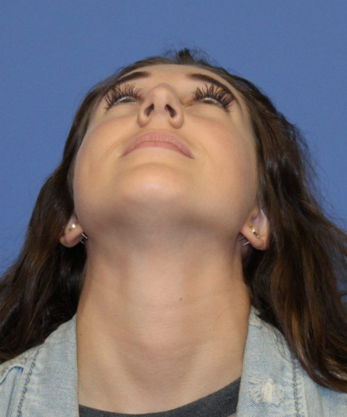 Rhinoplasty #6975 – click HERE for more views before photo. Individual results may vary.