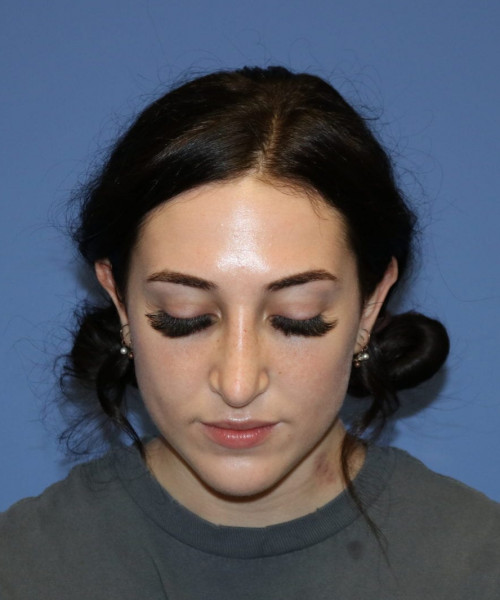 Rhinoplasty #6975 – click HERE for more views after photo. Individual results may vary.