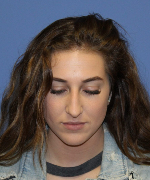 Rhinoplasty #6975 – click HERE for more views before photo. Individual results may vary.