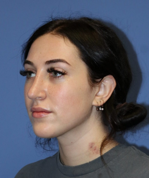 Rhinoplasty #6975 – click HERE for more views after photo. Individual results may vary.
