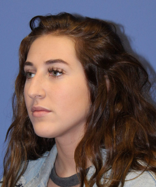 Rhinoplasty #6975 – click HERE for more views before photo. Individual results may vary.