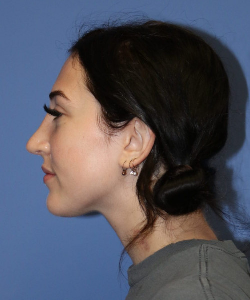 Rhinoplasty #6975 – click HERE for more views after photo. Individual results may vary.