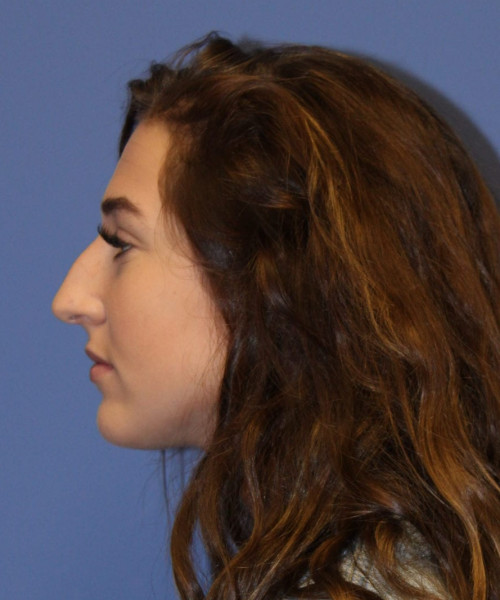 Rhinoplasty #6975 – click HERE for more views before photo. Individual results may vary.