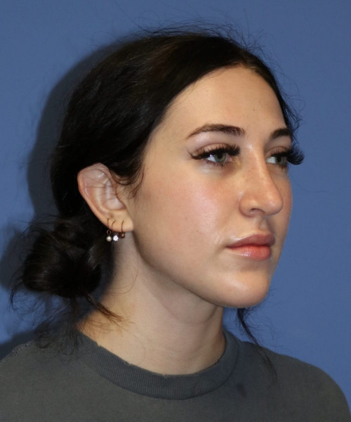 Rhinoplasty #6975 – click HERE for more views after photo. Individual results may vary.