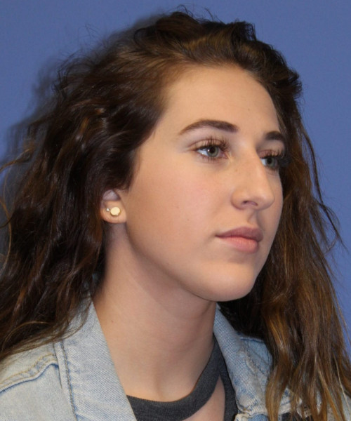 Rhinoplasty #6975 – click HERE for more views before photo. Individual results may vary.