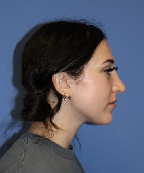 Rhinoplasty #6975 – click HERE for more views after photo. Individual results may vary.