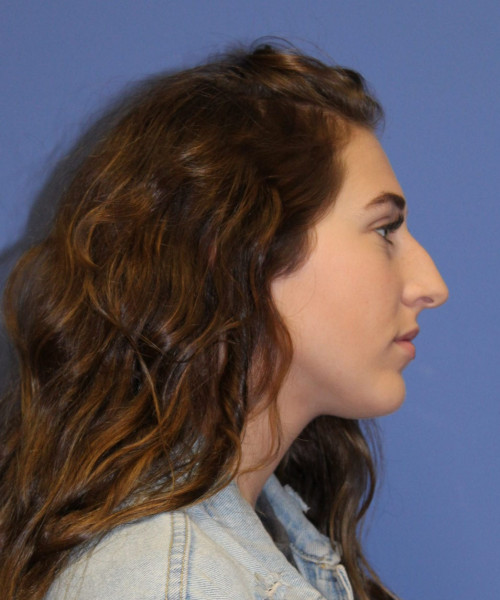 Rhinoplasty #6975 – click HERE for more views before photo. Individual results may vary.