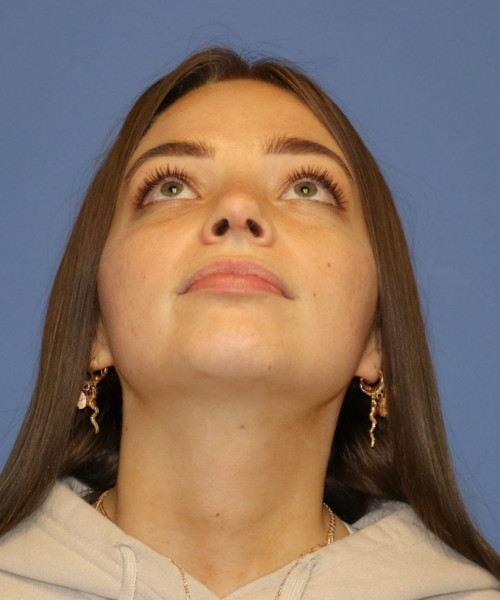 Rhinoplasty #6990 – click HERE for more views after photo. Individual results may vary.