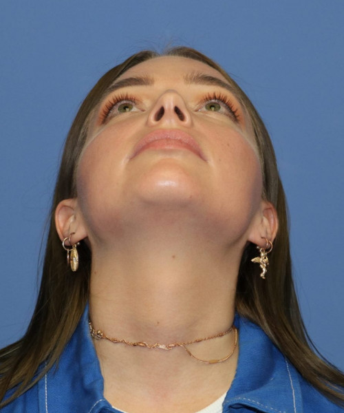 Rhinoplasty #6990 – click HERE for more views before photo. Individual results may vary.