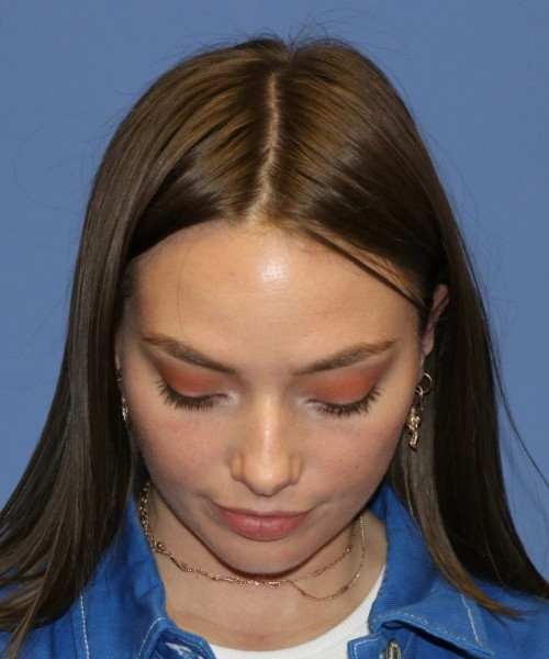 Rhinoplasty #6990 – click HERE for more views before photo. Individual results may vary.