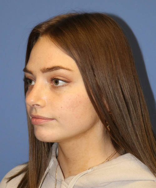 Rhinoplasty #6990 – click HERE for more views after photo. Individual results may vary.