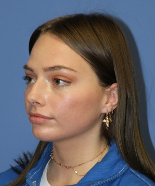Rhinoplasty #6990 – click HERE for more views before photo. Individual results may vary.