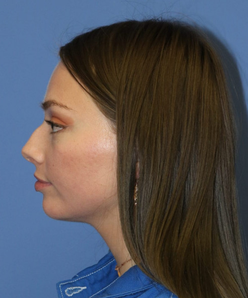 Rhinoplasty #6990 – click HERE for more views before photo. Individual results may vary.
