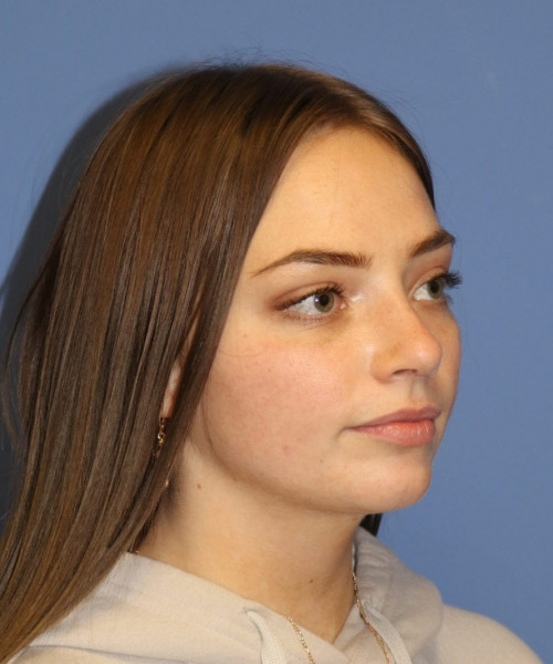 Rhinoplasty #6990 – click HERE for more views after photo. Individual results may vary.