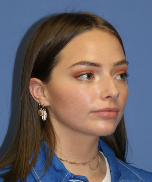 Rhinoplasty #6990 – click HERE for more views before photo. Individual results may vary.