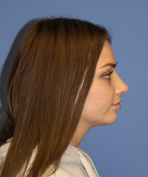 Rhinoplasty #6990 – click HERE for more views after photo. Individual results may vary.