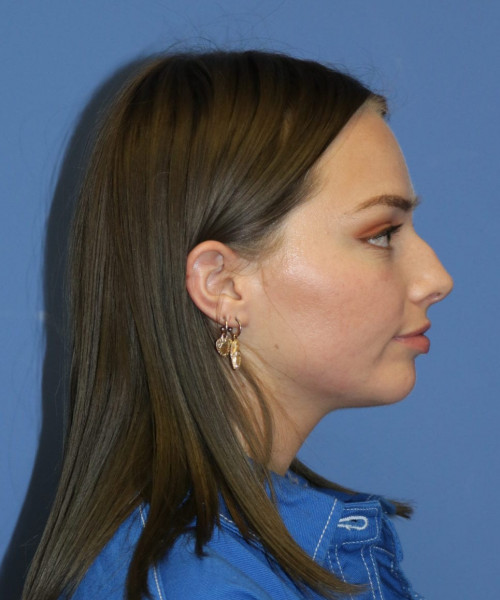 Rhinoplasty #6990 – click HERE for more views before photo. Individual results may vary.