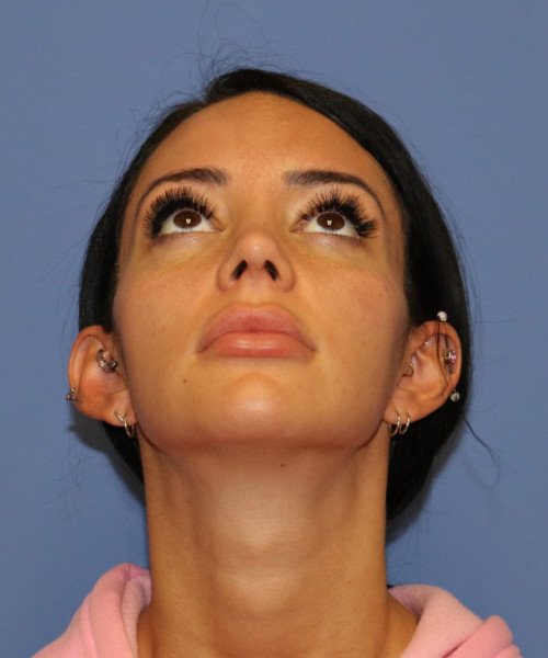 Rhinoplasty #7042 – click HERE for more views after photo. Individual results may vary.