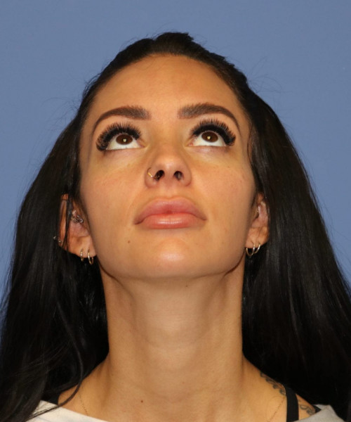 Rhinoplasty #7042 – click HERE for more views before photo. Individual results may vary.